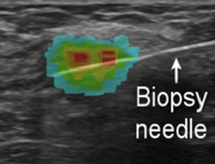 La aguja de biopsia guiada por información molecular en tiempo real