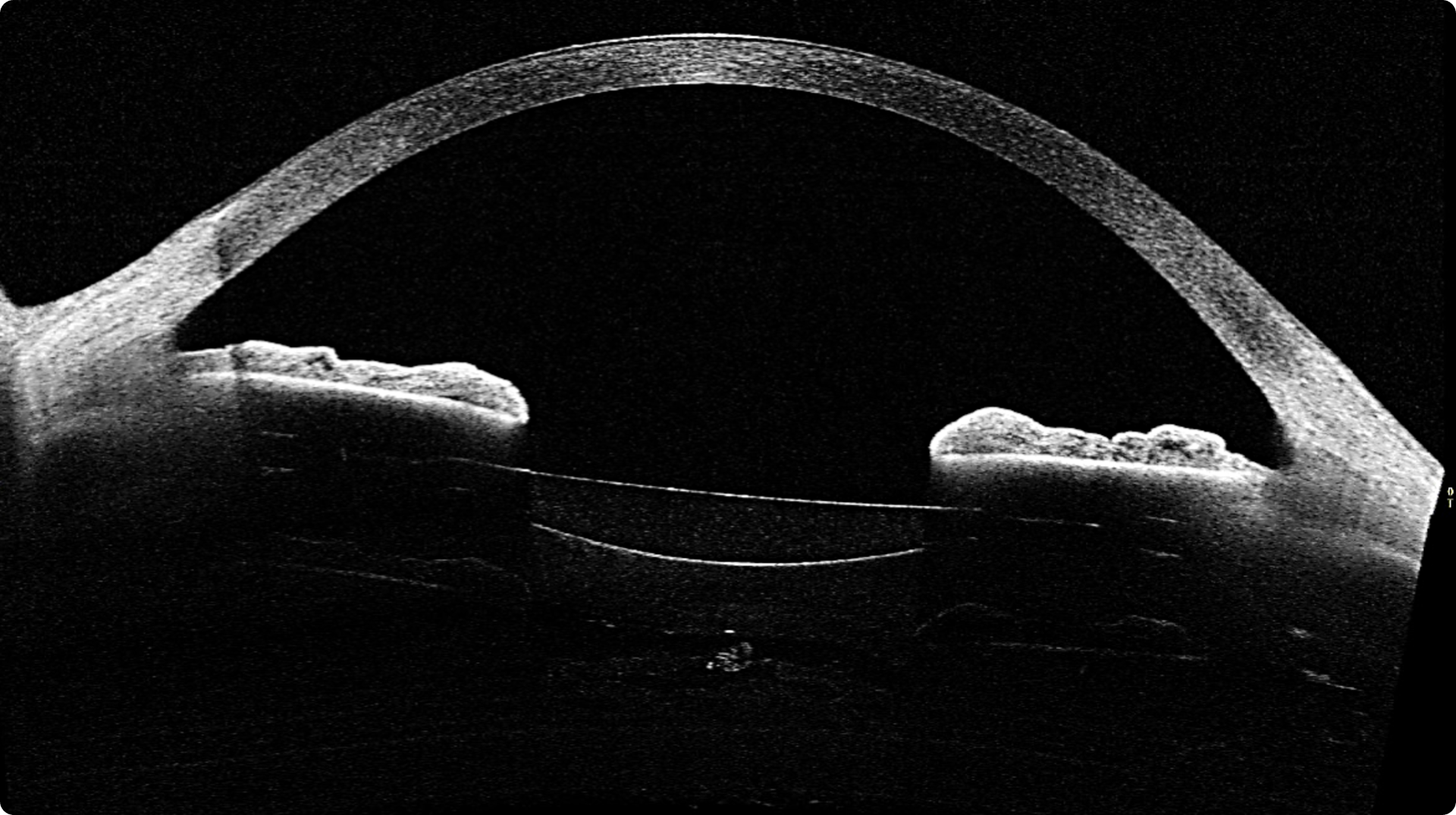 Imagen de lente Artiol Implantada